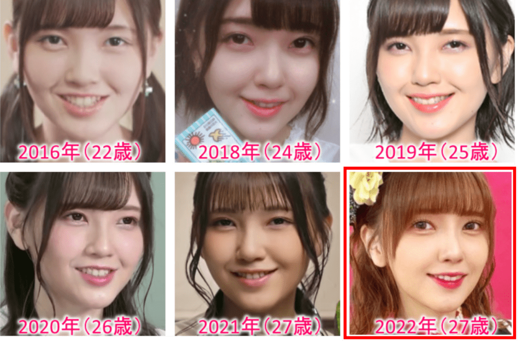 伊藤かりんの整形疑惑